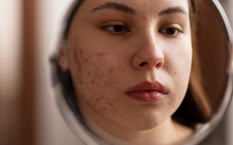 A imagem mostra uma mulher com acne no rosto se olhando no espelho. A acne é visível nas bochechas, nariz e testa. A mulher tem uma expressão neutra no rosto e seu cabelo está preso em um rabo de cavalo.