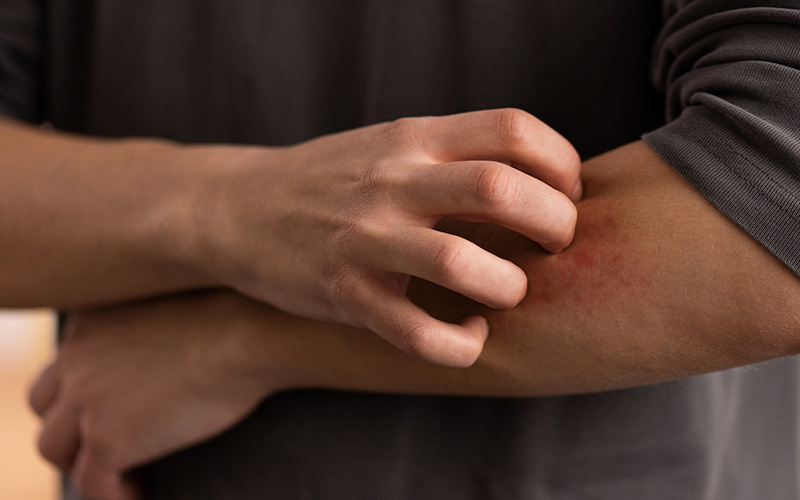 A imagem mostra um homem com manchas vermelhas no braço. As manchas são provavelmente causadas por uma erupção cutânea ou outra doença da pele. O homem está vestindo uma camisa cinza e está com os braços cruzados à sua frente.
