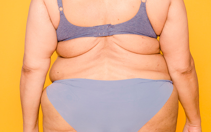 Imagem mostra uma mulher de costas que esta vestida com um biquini azul claro. A mulher tem muita gordura localizada porque o texto trata de obesidade